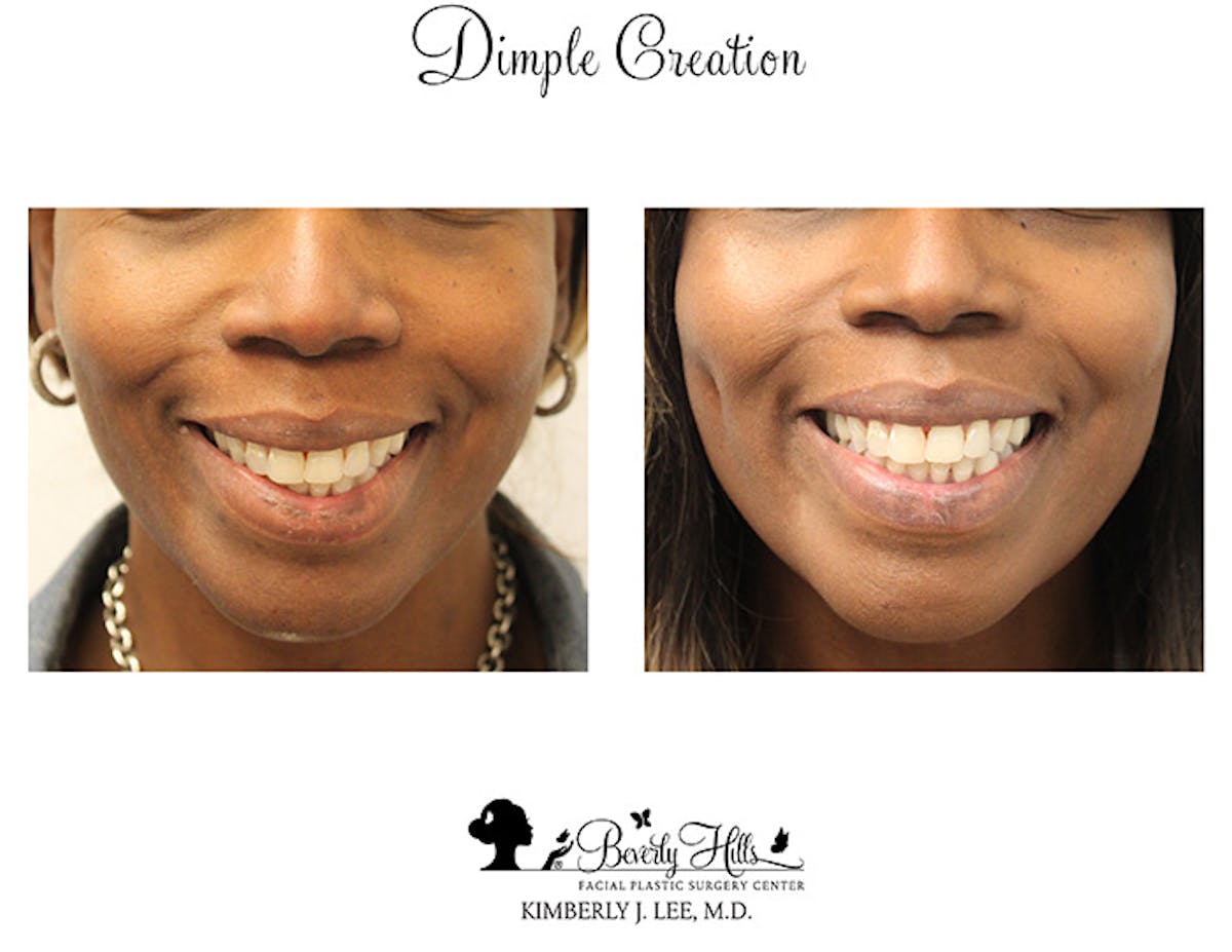 Dimple Creation Before & After Gallery - Patient 85939977 - Image 3