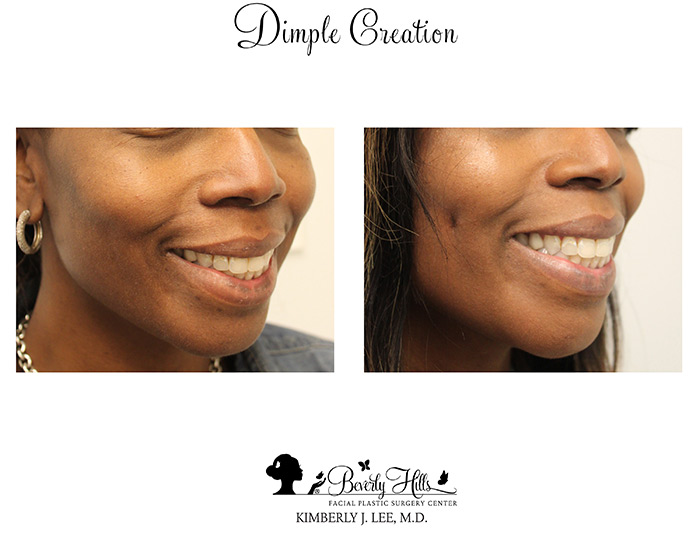 Dimple Creation Before & After Photos Dr. Kimberly Lee