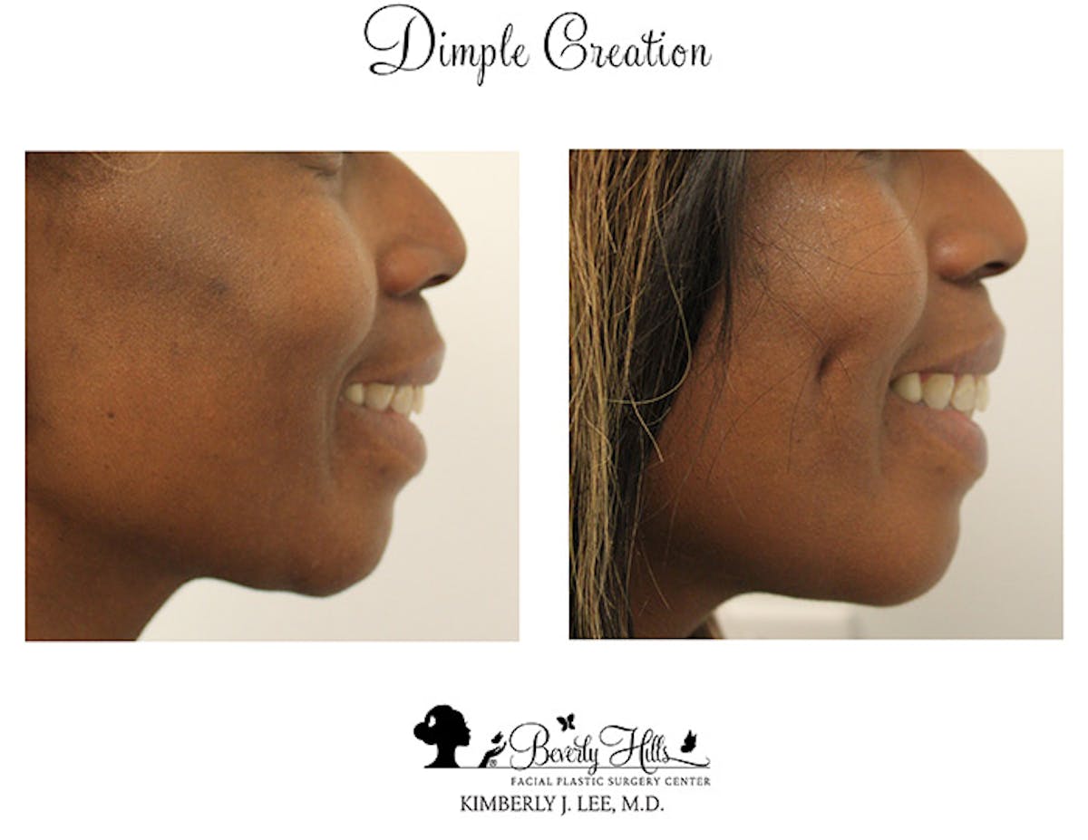 Dimple Creation Before & After Gallery - Patient 85939977 - Image 1
