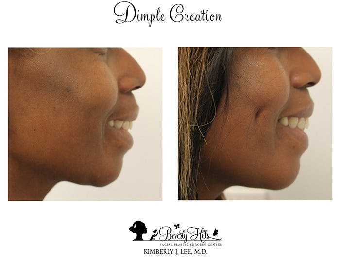 Dimple Creation Before & After Gallery - Patient 85939977 - Image 1