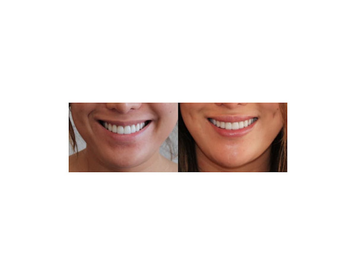 Dimple Creation Before & After Gallery - Patient 85939980 - Image 1