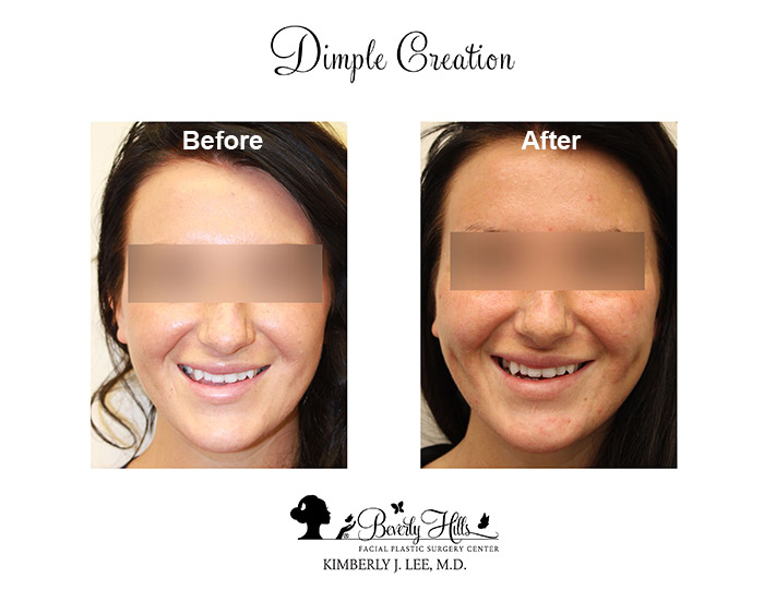 Patient 85939981 | Dimple Creation Before & After Photos | Dr