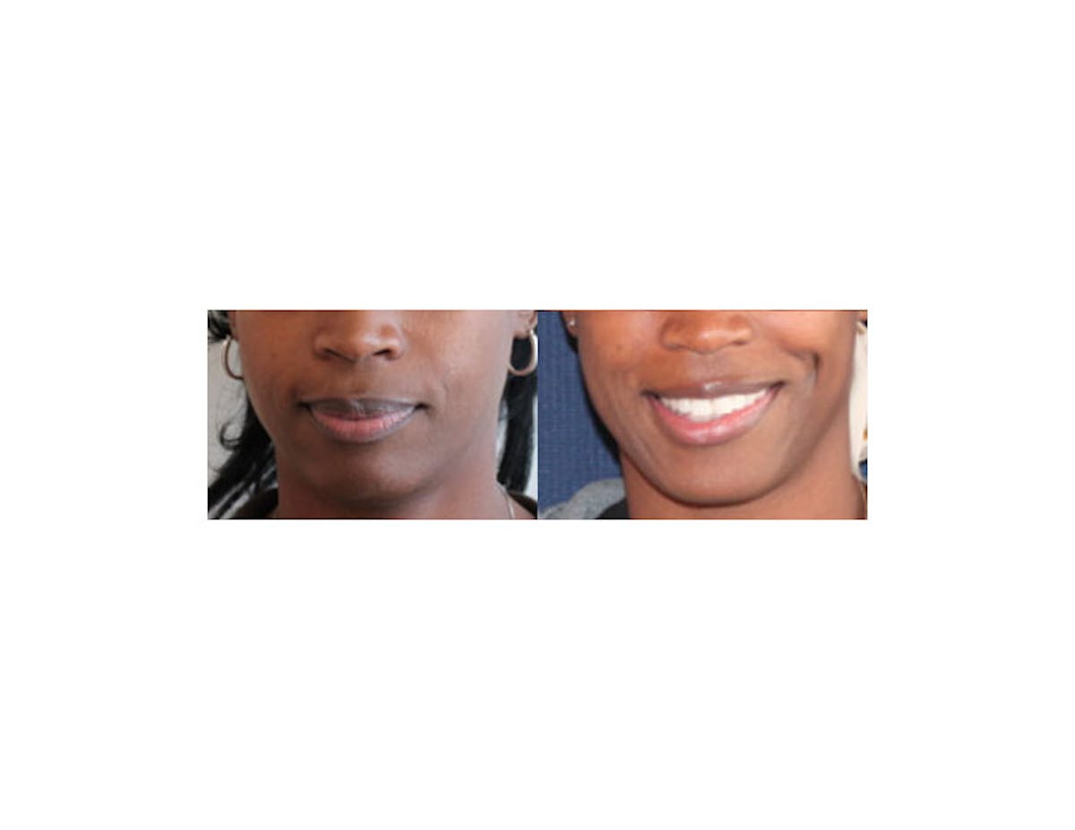 Dimple Creation Before & After Gallery - Patient 85939984 - Image 1