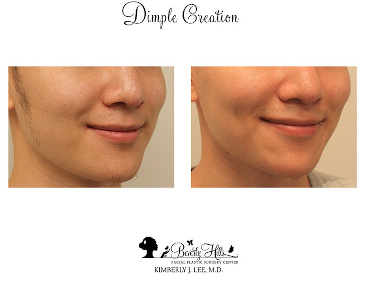 Dimple Creation Before & After Gallery - Patient 85939985 - Image 3