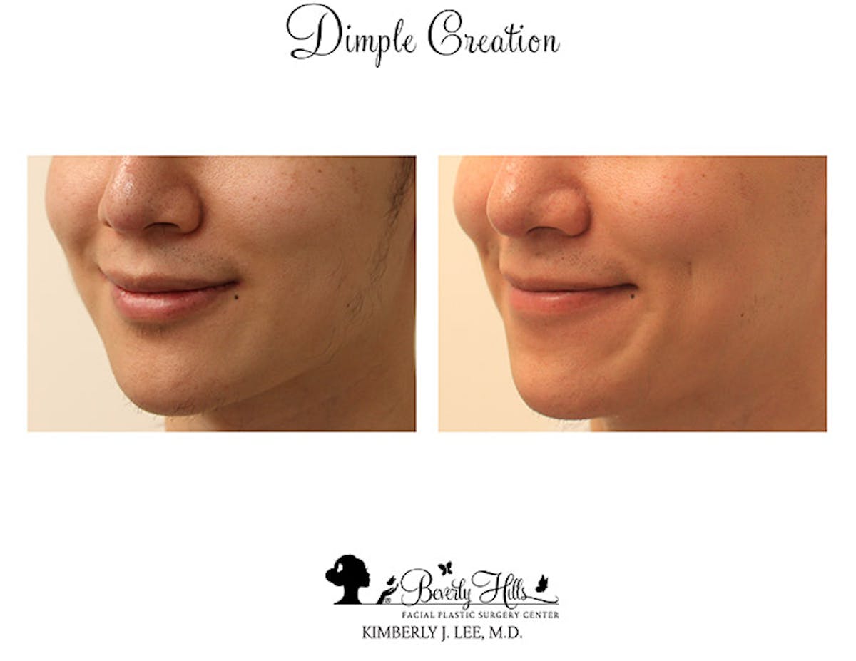 Dimple Creation Before & After Gallery - Patient 85939985 - Image 2