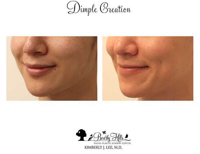 Dimple Creation Before & After Gallery - Patient 85939985 - Image 2
