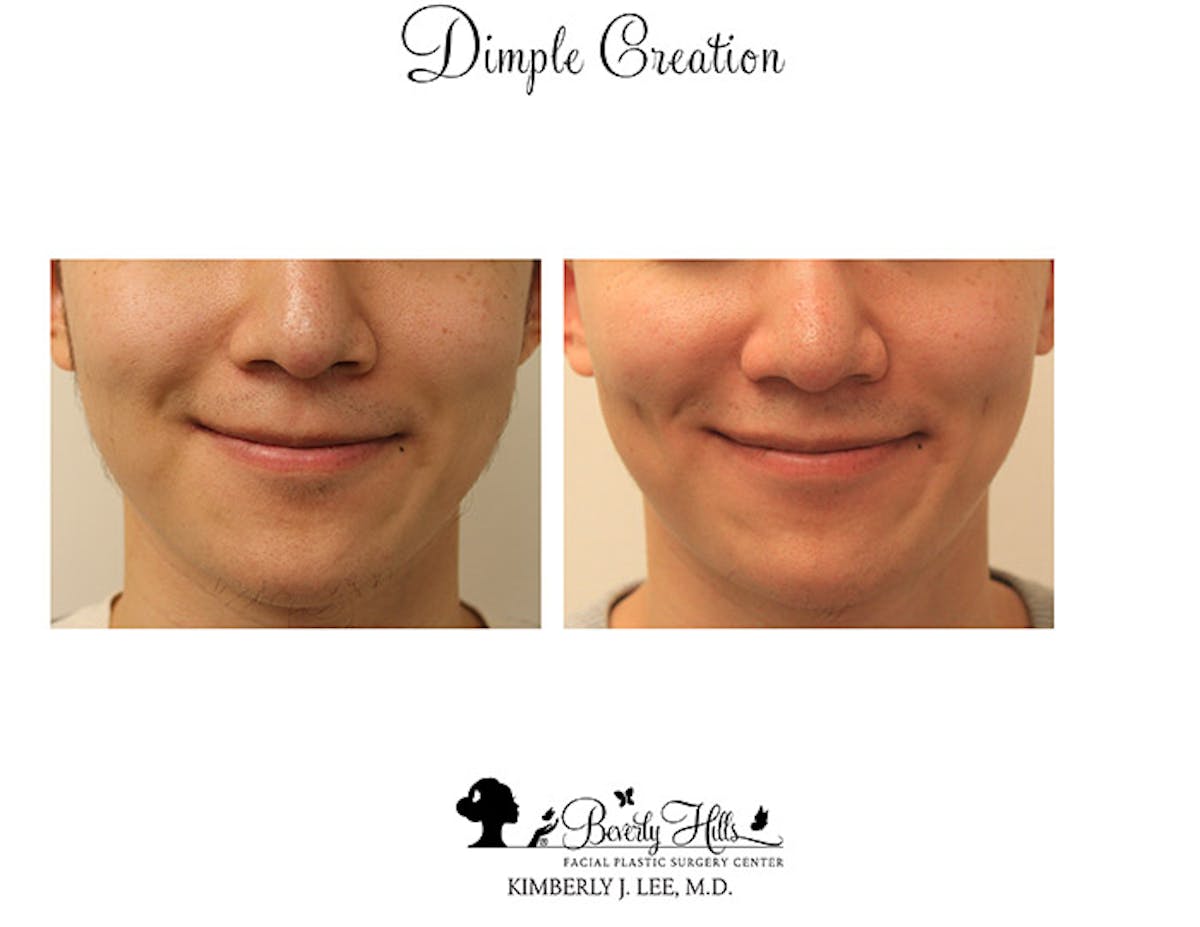 Dimple Creation Before & After Gallery - Patient 85939985 - Image 1
