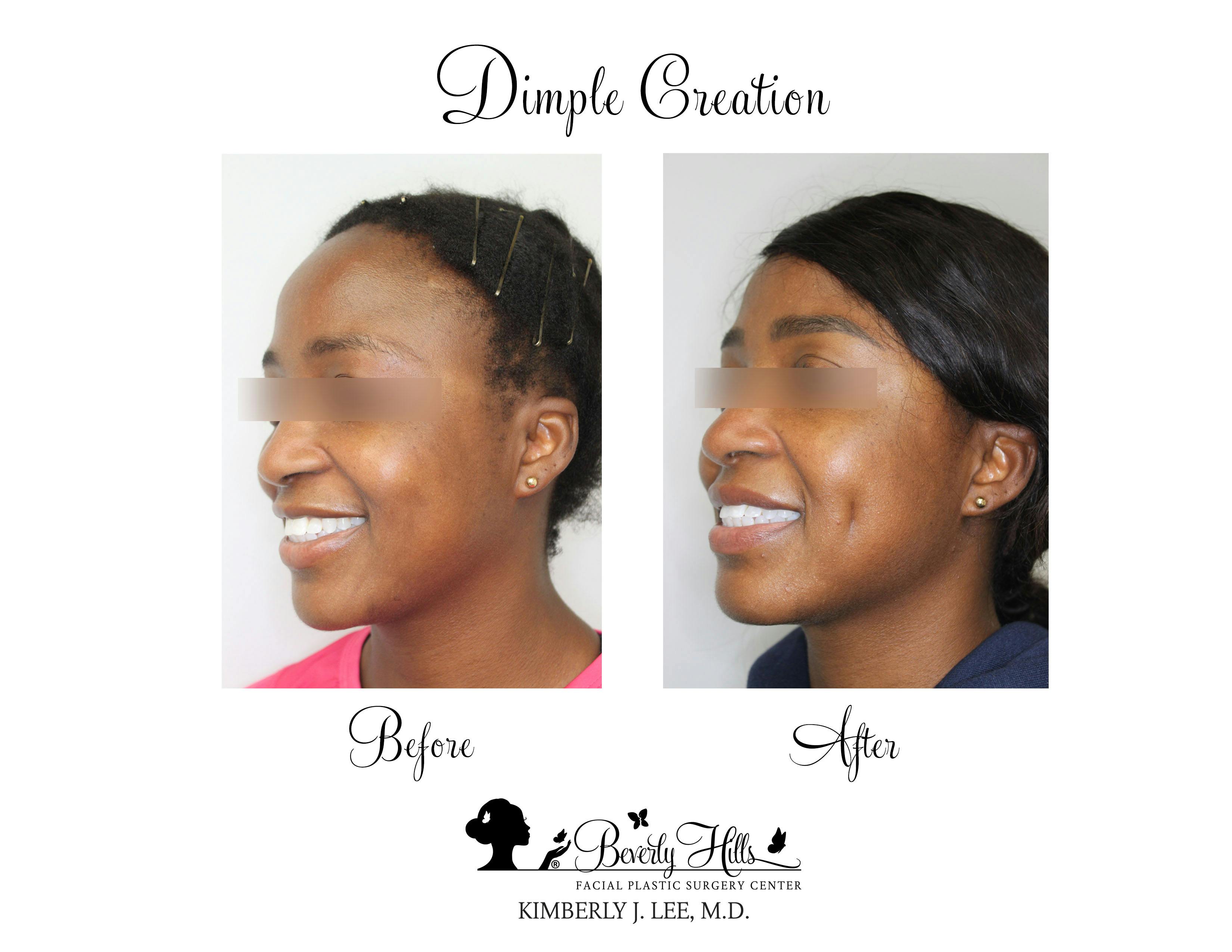 Dimple Creation Gallery - Patient 85939988 - Image 2