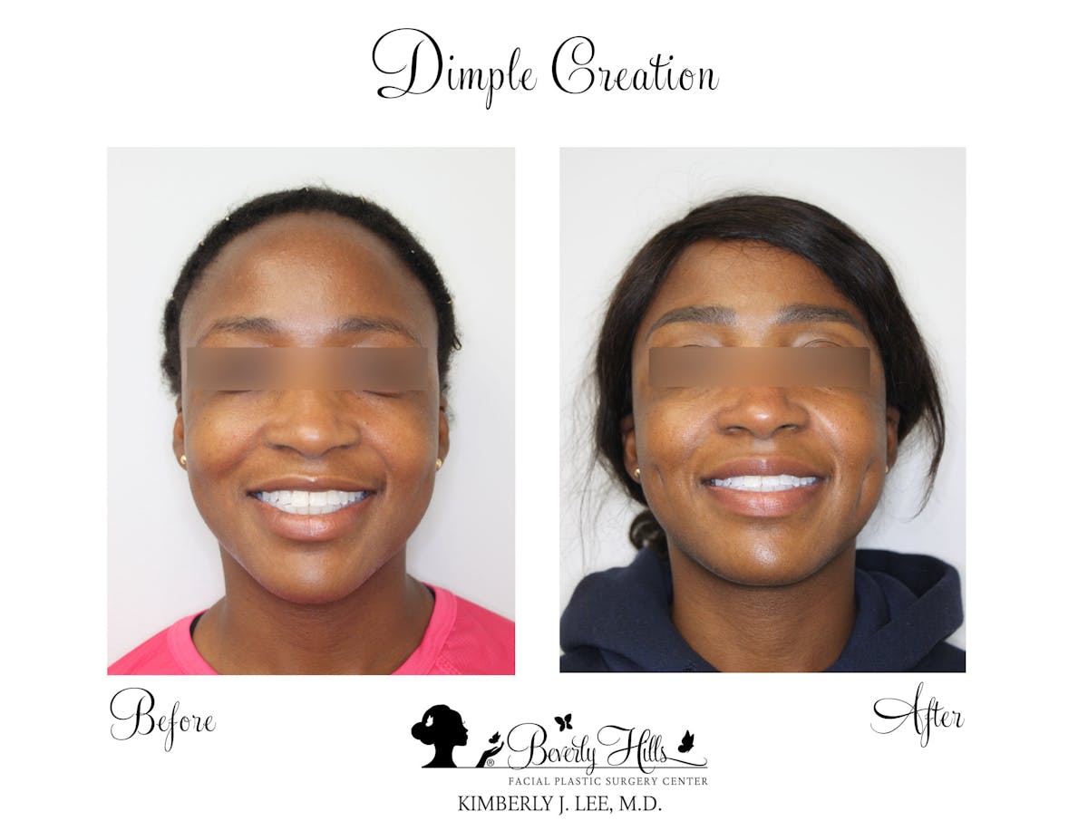 Dimple Creation Before & After Gallery - Patient 85939988 - Image 1