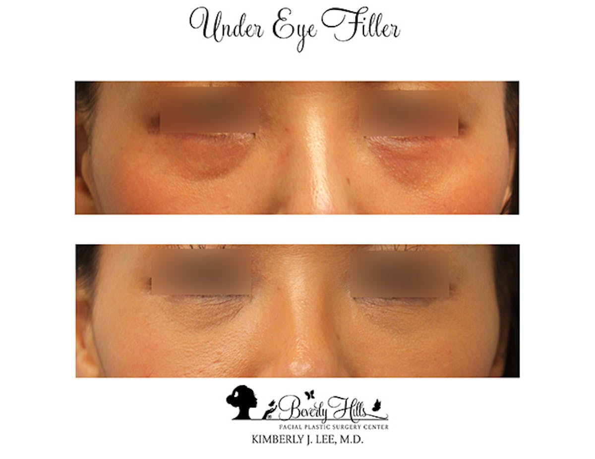 Facial Fillers Before & After Gallery - Patient 85944407 - Image 1