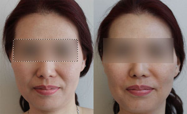 Facial Fillers Gallery - Patient 85944406 - Image 1