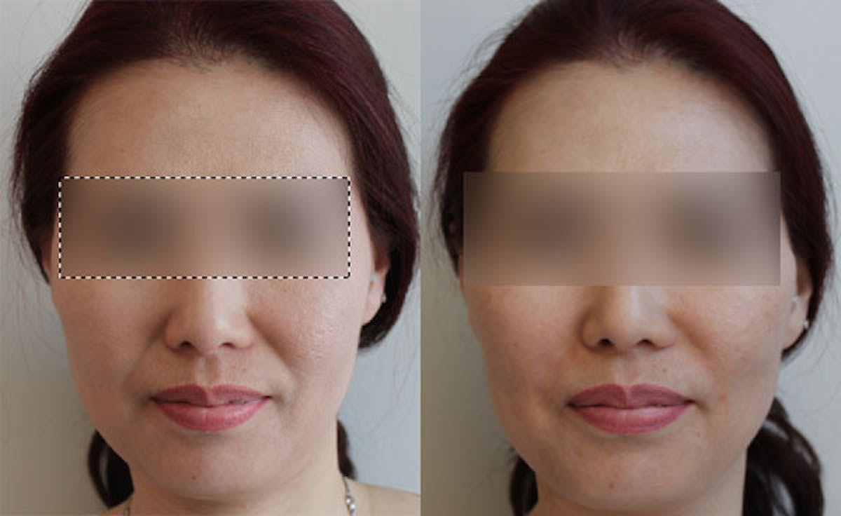 Facial Fillers Before & After Gallery - Patient 85944406 - Image 1