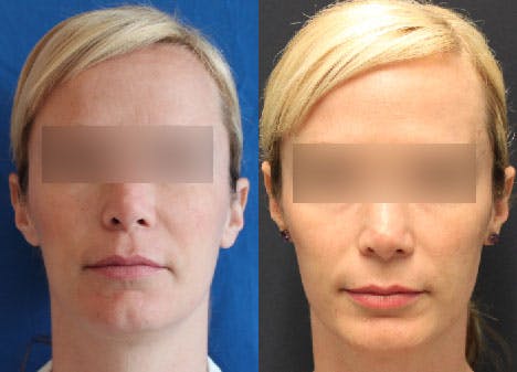 Facial Fillers Gallery - Patient 85944405 - Image 1