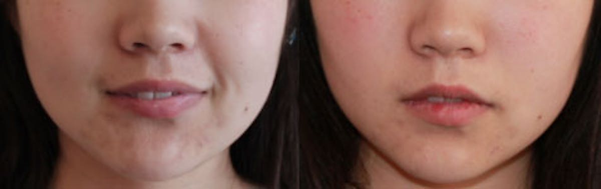 Facial Fillers Before & After Gallery - Patient 85944404 - Image 1