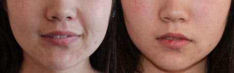 Facial Fillers Before & After Gallery - Patient 85944404 - Image 1