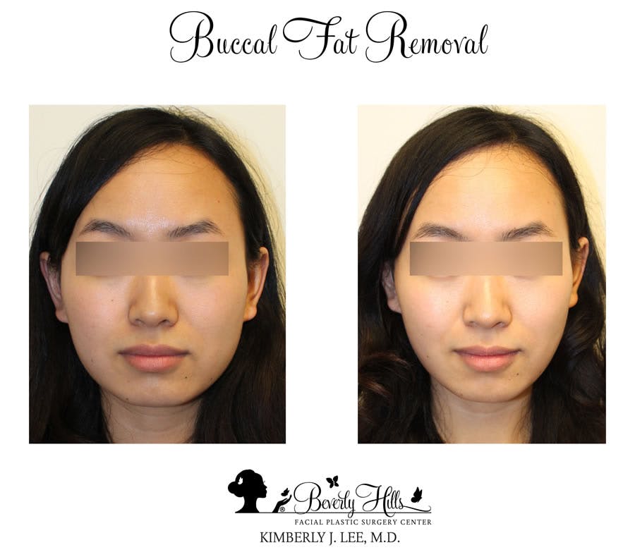 Buccal Fat Removal