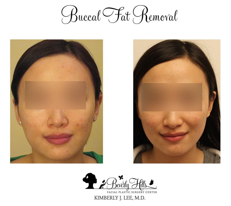 Buccal Fat Removal Before & After Gallery - Patient 85944480 - Image 1