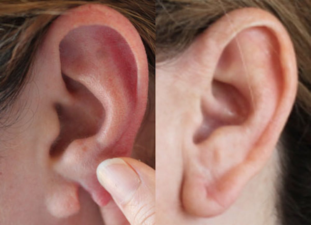 Earlobe Repair Before & After Gallery - Patient 85944514 - Image 1