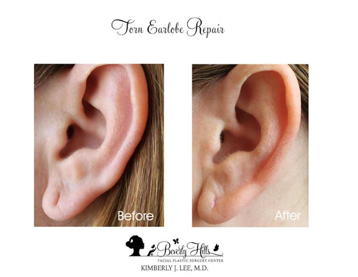 Earlobe Repair Surgery, Miami, FL