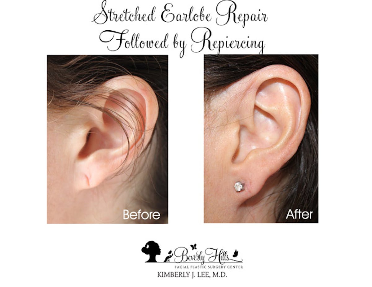 Earlobe Repair Before & After Gallery - Patient 85944516 - Image 1