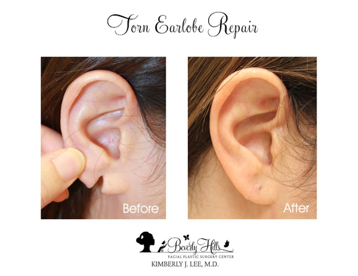 Earlobe Repair Before & After Gallery - Patient 85944517 - Image 1