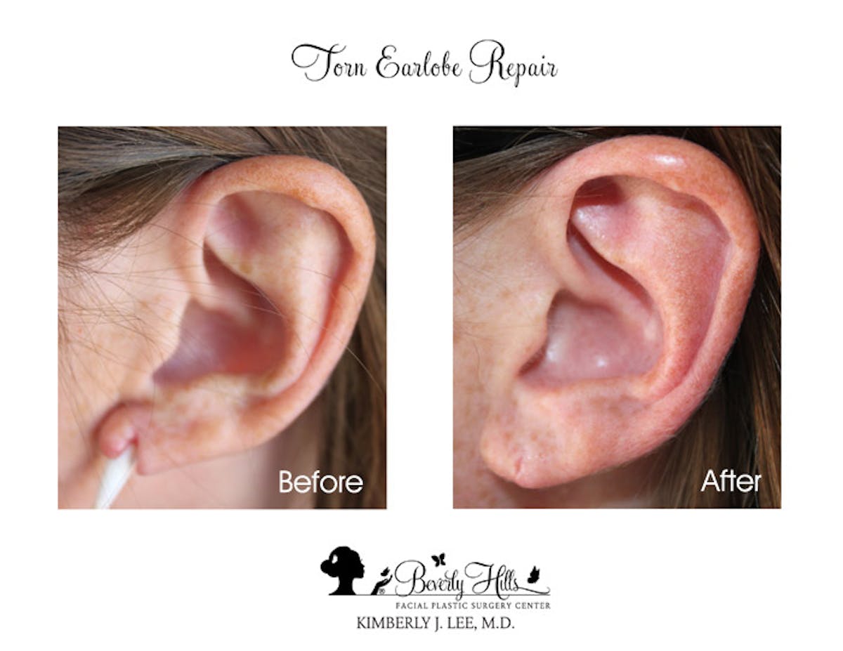 Earlobe Repair  Virginia, Washington D.C. and Maryland