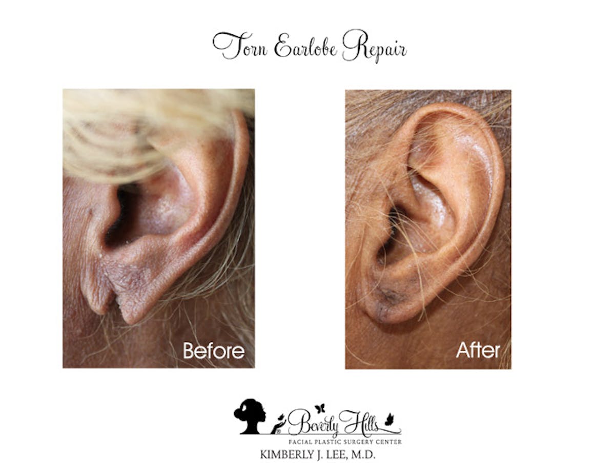 Earlobe Repair Before & After Gallery - Patient 85944519 - Image 1