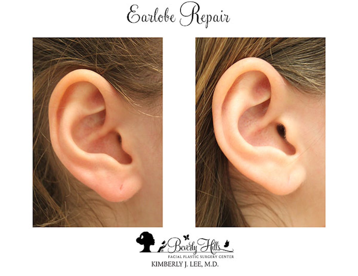 Earlobe Repair Before & After Gallery - Patient 85944520 - Image 1