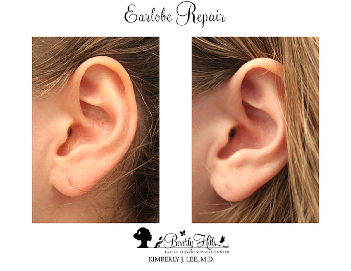 Earlobe Repair Before & After Gallery - Patient 85944520 - Image 2