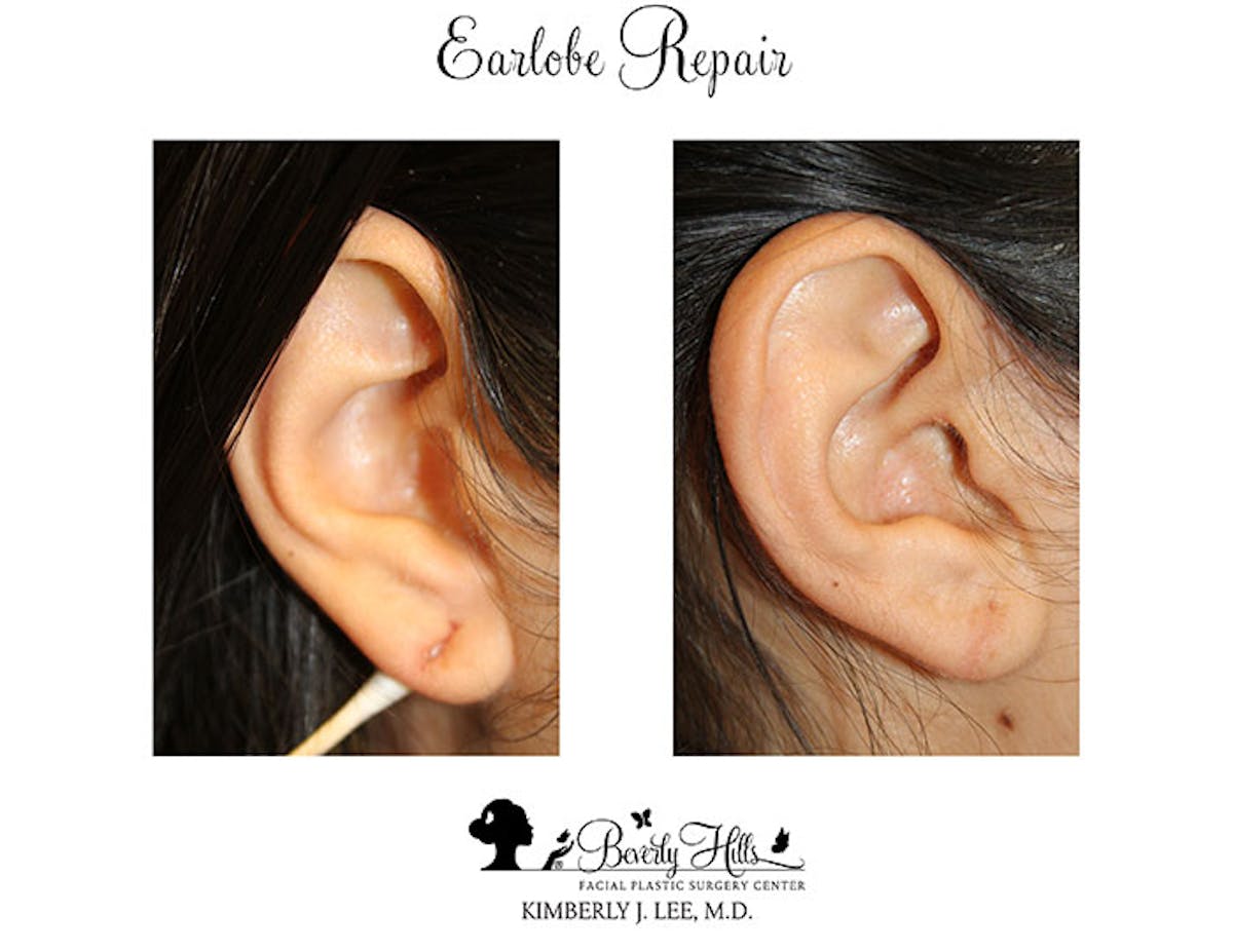 Earlobe Repair Before & After Gallery - Patient 85944523 - Image 1