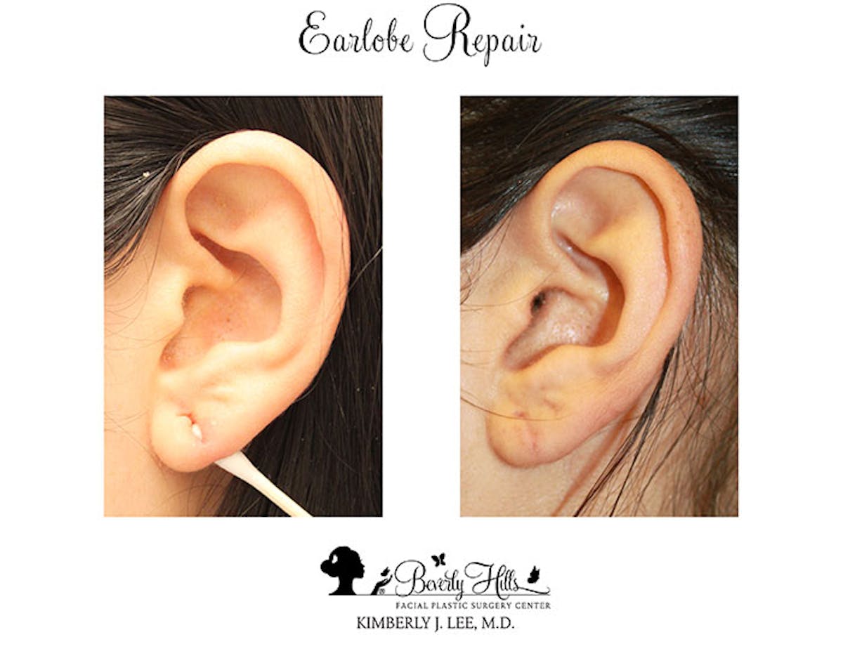 Earlobe Repair Before & After Gallery - Patient 85944523 - Image 2