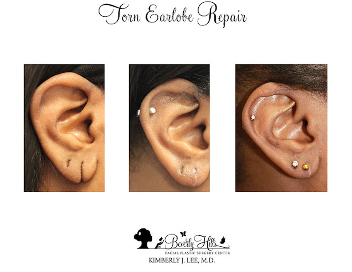 Earlobe Repair Before & After Gallery - Patient 85944525 - Image 2