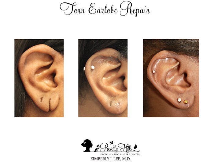 Earlobe Repair Before & After Gallery - Patient 85944525 - Image 2