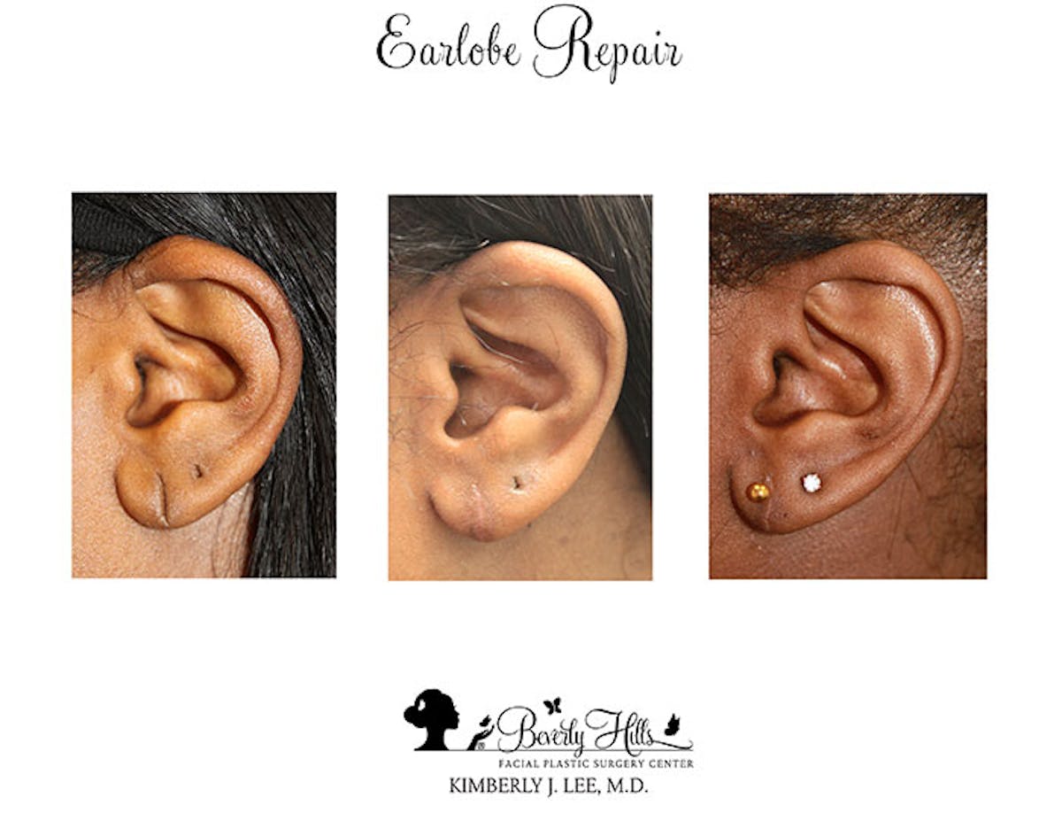 Earlobe Repair Before & After Gallery - Patient 85944525 - Image 1