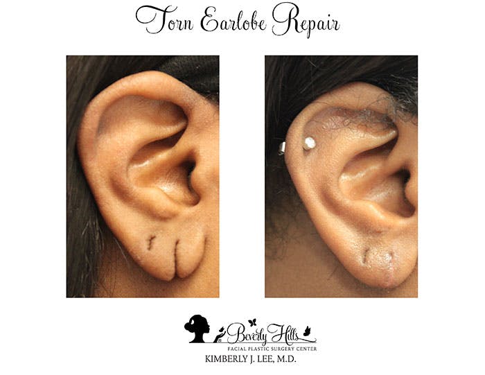 Earlobe Repair Before & After Gallery - Patient 85944525 - Image 3