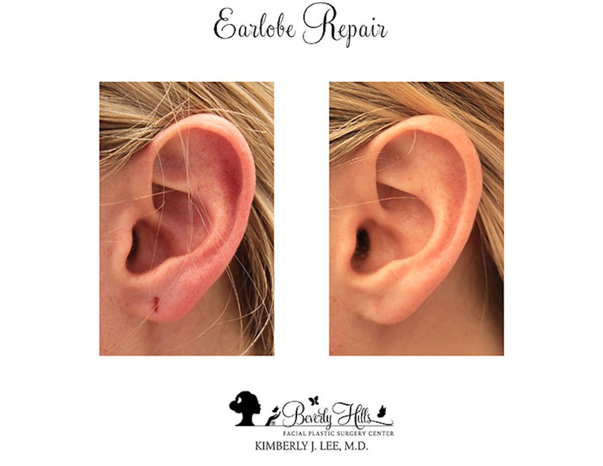 Earlobe Repair Before & After Gallery - Patient 85944528 - Image 1