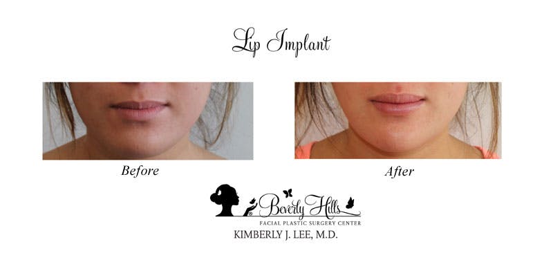 Lip Implants