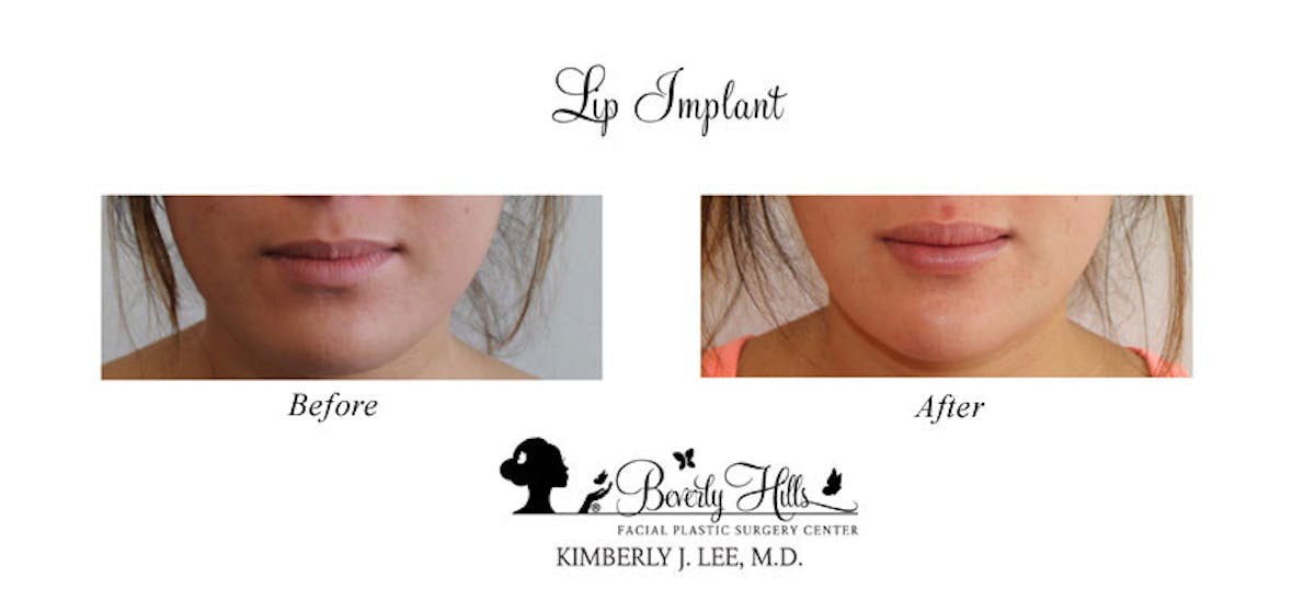 Lips Before & After Gallery - Patient 85944538 - Image 1