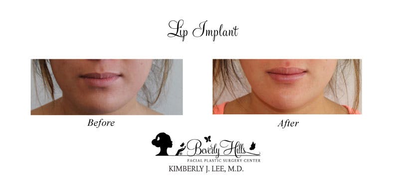 Lips Gallery - Patient 85944538 - Image 1