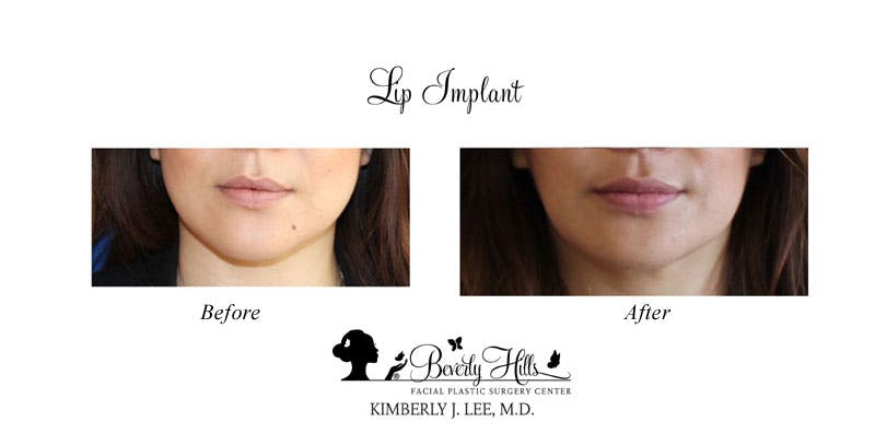 Lips Before & After Gallery - Patient 85944540 - Image 1