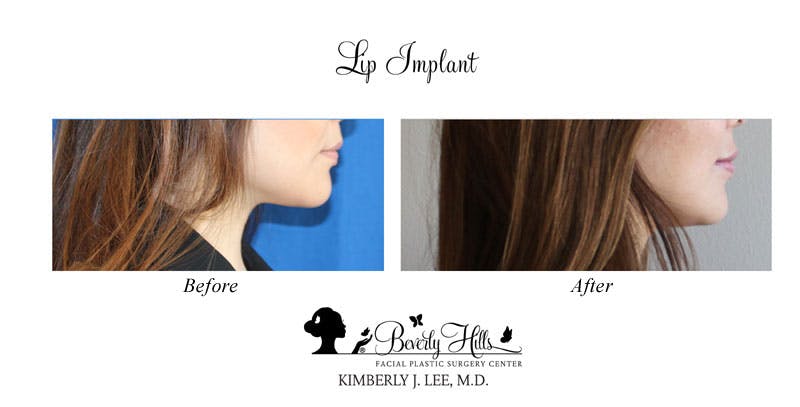 Lips Before & After Gallery - Patient 85944540 - Image 2