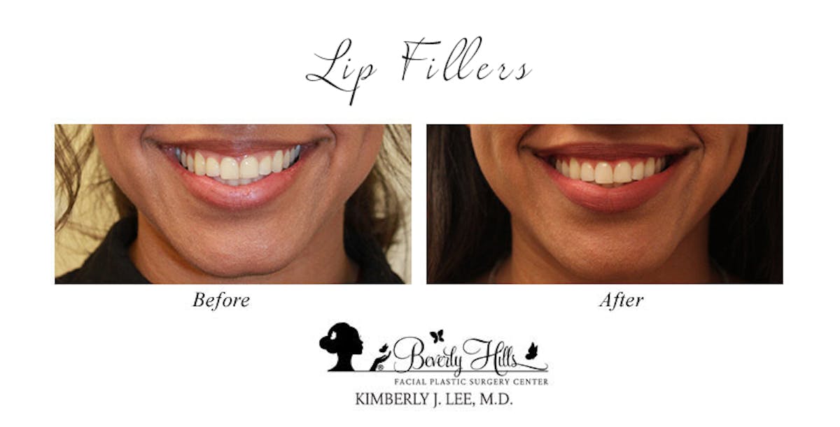 Lips Before & After Gallery - Patient 85944542 - Image 1