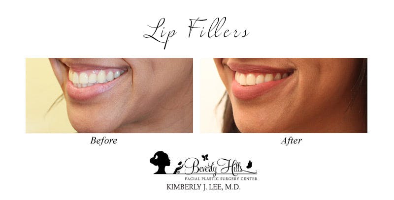 Lips Before & After Gallery - Patient 85944542 - Image 2