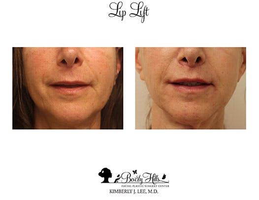 Lip Lift in Beverly Hills & Los Angeles Before & After Photos