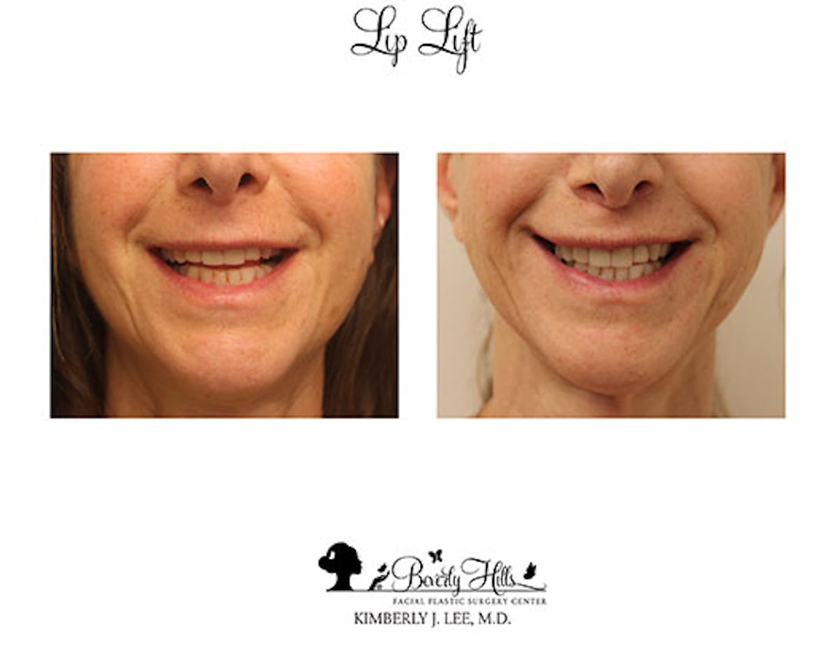 Lips Before & After Gallery - Patient 85944544 - Image 2