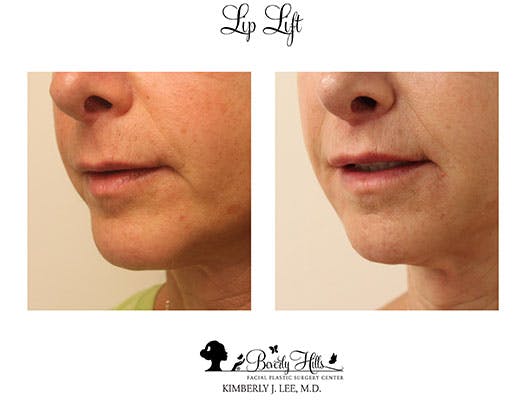 Lips Before & After Gallery - Patient 85944544 - Image 3