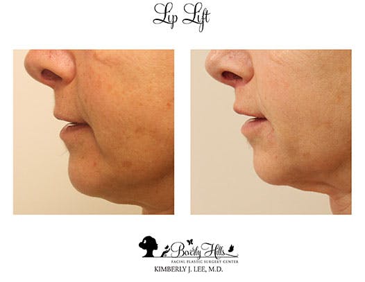 Lips Before & After Gallery - Patient 85944544 - Image 4