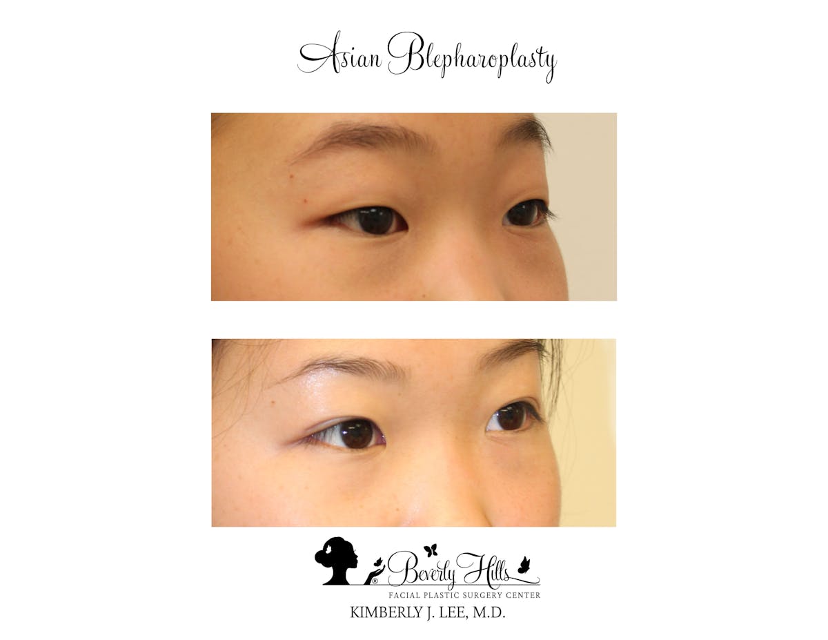 Eyelids Before & After Gallery - Patient 85944559 - Image 2