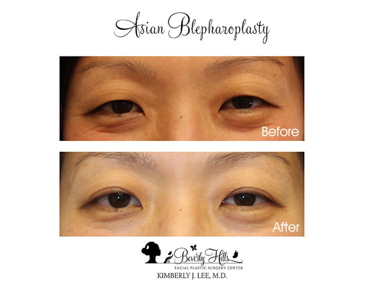 Eyelids Before & After Gallery - Patient 85944562 - Image 1