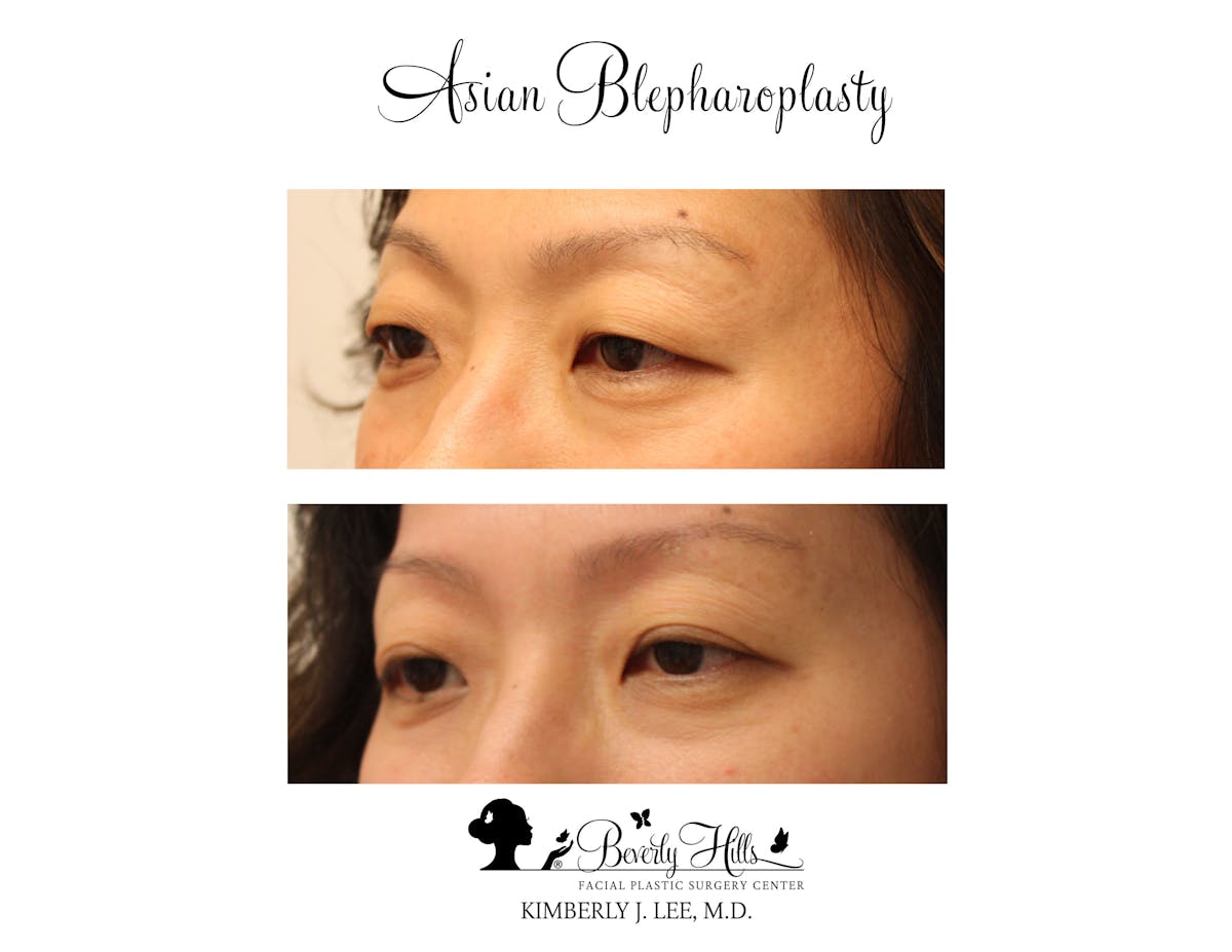 Eyelids Before & After Gallery - Patient 85944562 - Image 3
